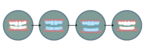 the Invisalign process - Boroughbridge Dental Practice - Ripon