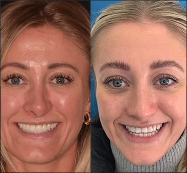 Woman before and after Invisalign treatment at Ripon dental practice
