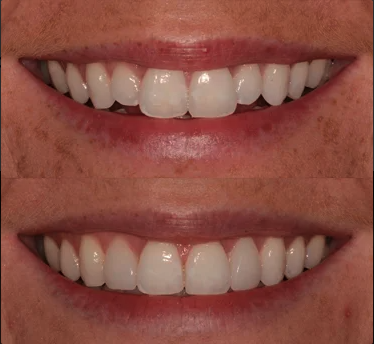Woman before and after Invisalign braces in Ripon dental practice