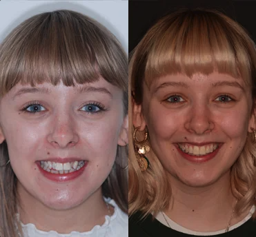 Girl before and after Invisalign braces treatment at Ripon dental practice