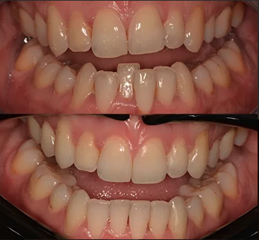 Before and after of Invisalign braces treatment at Ripon dental practice