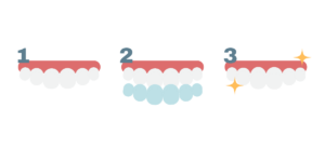 the Invisalign process at Boroughbridge dental practice in Ripon