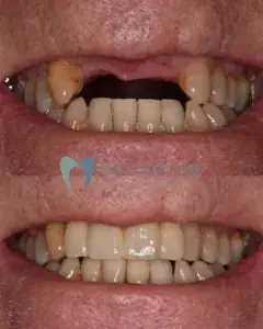 dental implant before and after 1