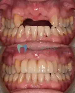 dental implant before and after