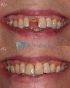 implant before and after at boroughbridge dental centre