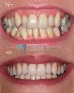 Before and After Clear Aligners