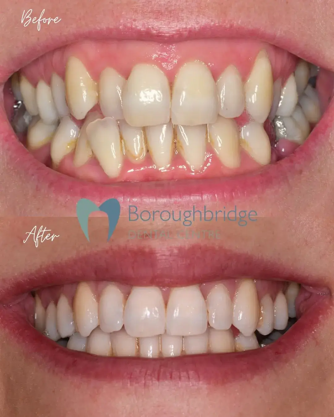 Before and After Clear Aligners