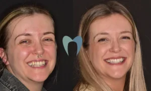 Before and After Clear Aligners