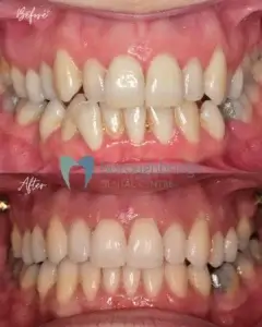 Before and After Clear Aligners