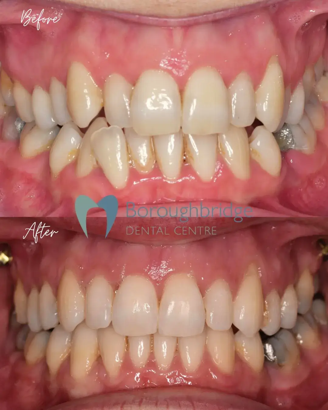 Before and After Clear Aligners
