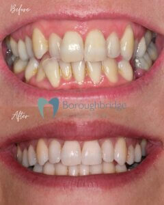 Clear Aligners