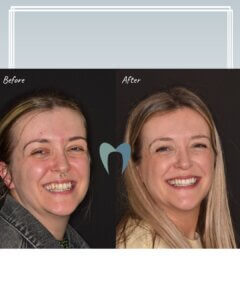Clear Aligners
