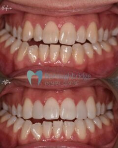 Composite Bonding