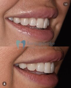 Composite Bonding