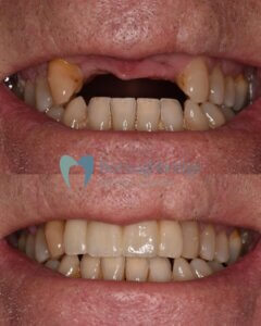 Dental Implants