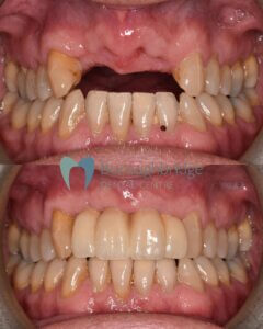 Dental Implants