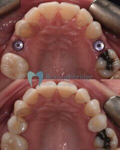 Dental Implants