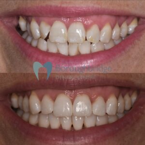 Clear Aligners