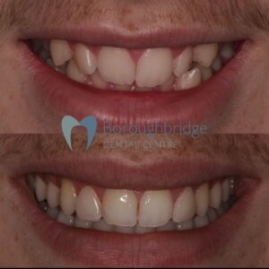 Clear Aligners
