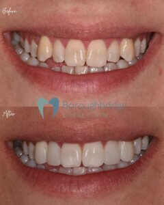 Composite Bonding