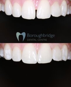 Composite Bonding