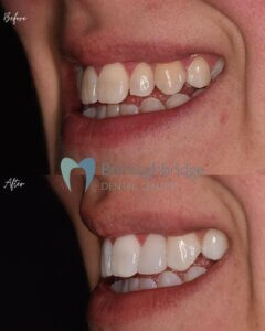 Composite Bonding