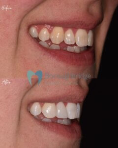 Composite Bonding