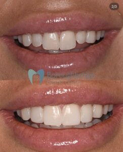 Composite Bonding