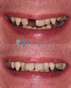 Dental Implants