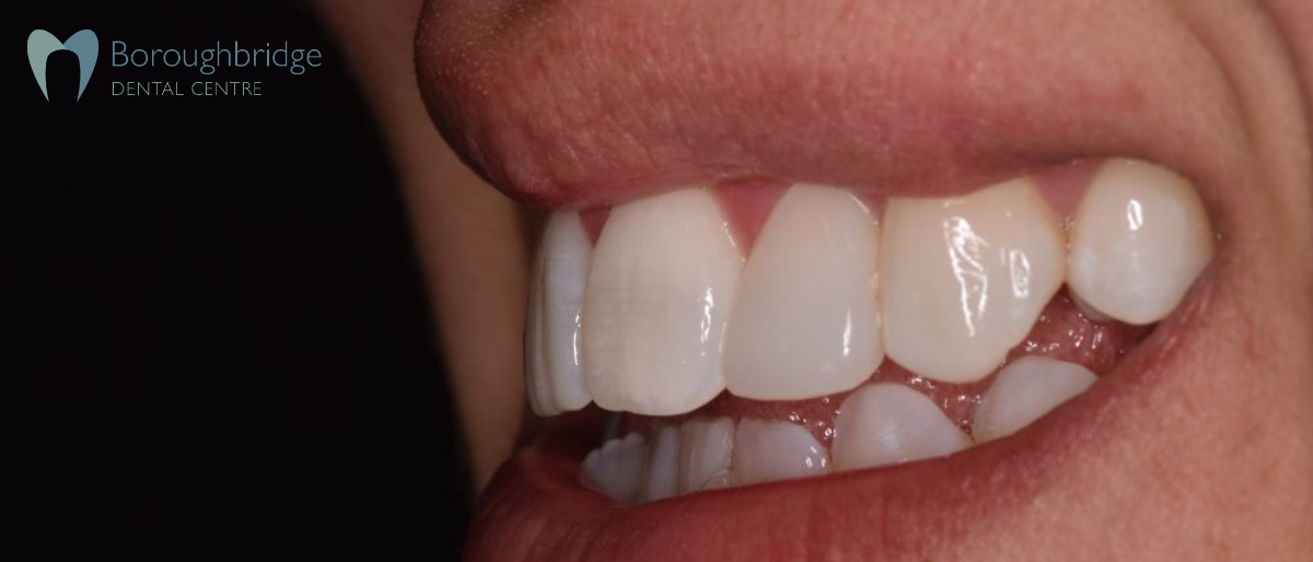 smile case befroe and after bonding