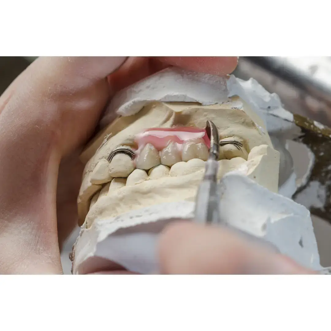 Partial denture made at Boroughbridge Dental Centre